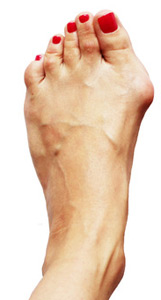 Hallux valgus