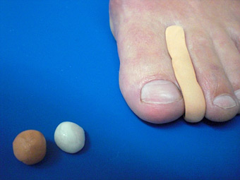 Zehenorthese bei Hallux valgus