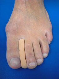 Zehenorthese bei Hallux valgus